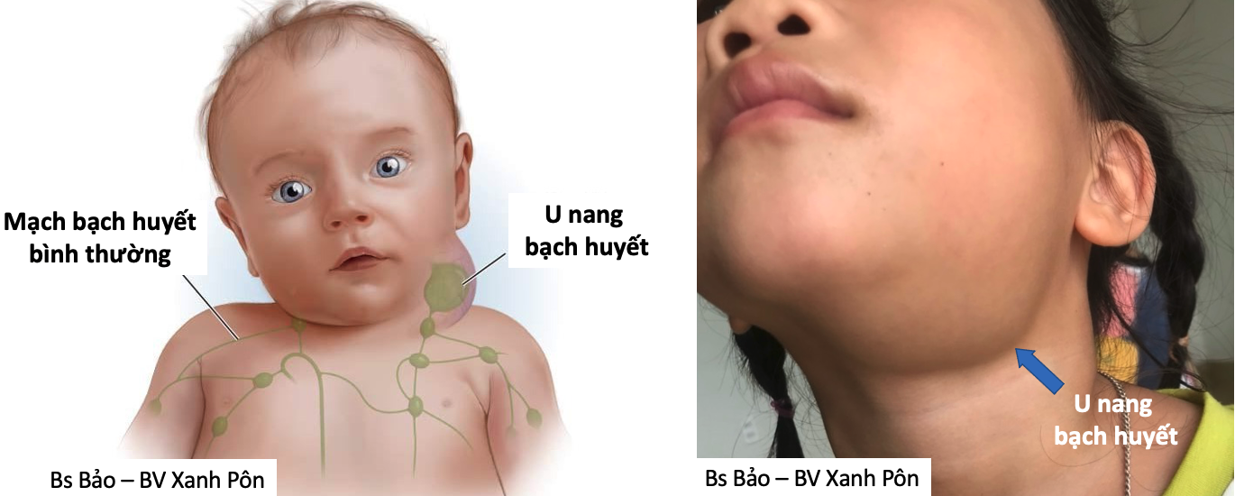 Điều trị U nang bạch huyết ở trẻ em