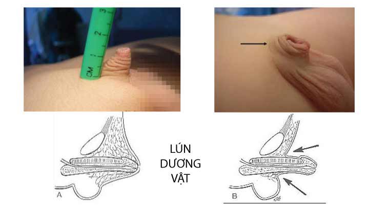 Lún dương vật (Vùi dương vật) ở nam giới: Nguyên nhân, biểu hiện và điều trị