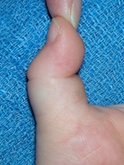 Điều trị bệnh Ngón tay lò xo (ngón tay cò súng) ở trẻ em