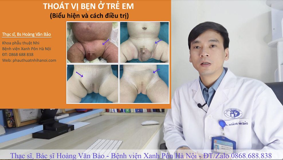 Điều trị thoát vị vùng bẹn ở trẻ em bằng phẫu thuật nội soi tại bệnh viện Xanh Pôn Hà Nội
