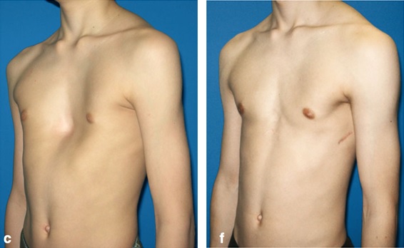 Điều trị bệnh lõm ngực ở trẻ em