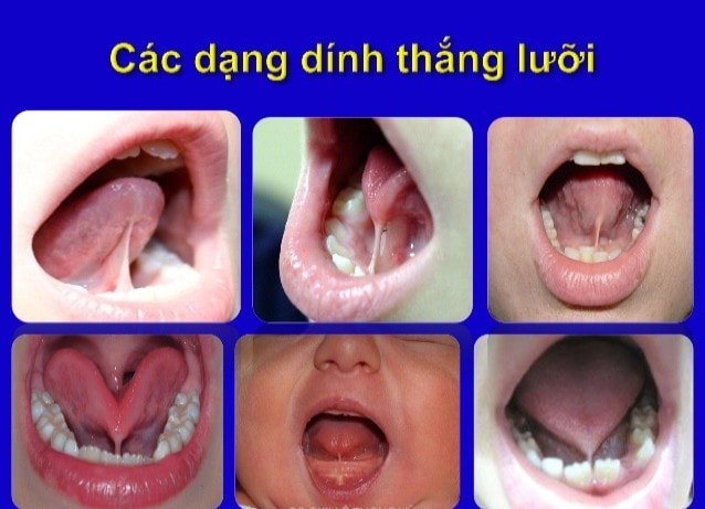 DẤU HIỆU NHẬN BIẾT TRẺ BỊ DÍNH THẮNG LƯỠI