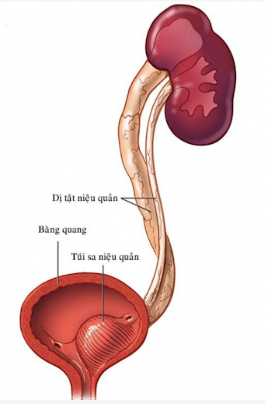 THẬN - NIỆU QUẢN ĐÔI