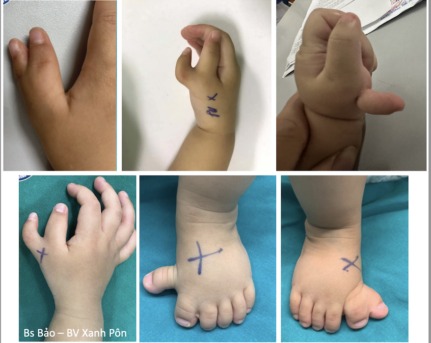 Di tật thừa ngón tay, ngón chân ở trẻ em