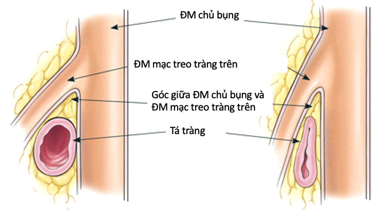 HỘI CHỨNG ĐỘNG MẠCH MẠC TREO TRÀNG TRÊN