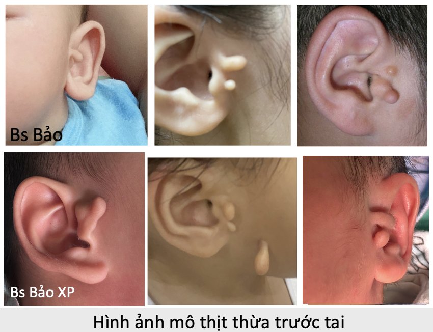 Điều trị dị tật Mô thịt thừa (Sụn thừa) trước tai ở trẻ em
