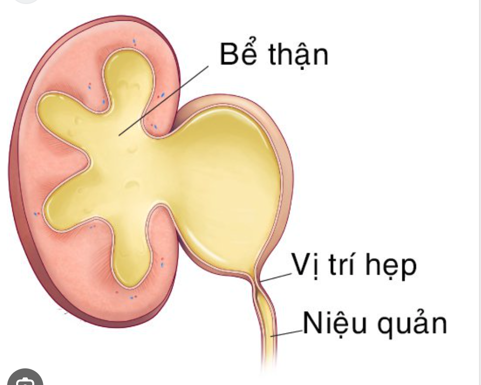 THẬN NƯỚC DO HẸP KHÚC NỐI BỂ THẬN - NIỆU QUẢN