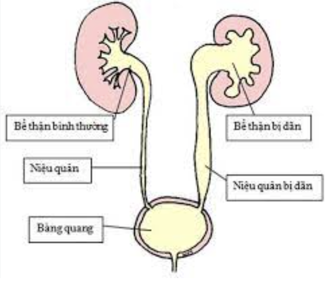 PHÌNH NIỆU QUẢN