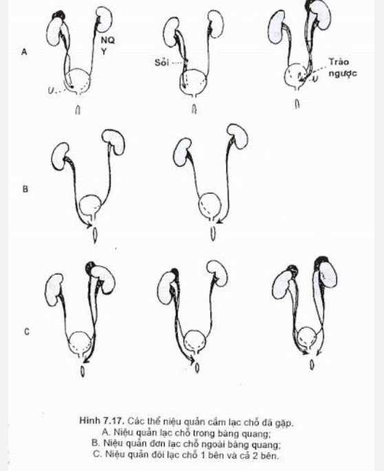 NIỆU QUẢN LẠC CHỖ