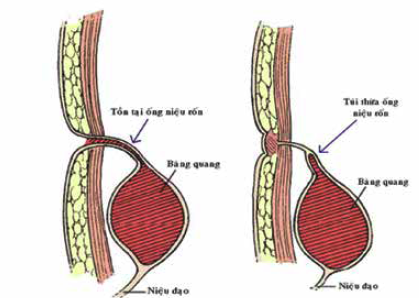 BỆNH LÝ ỐNG NIỆU - RỐN