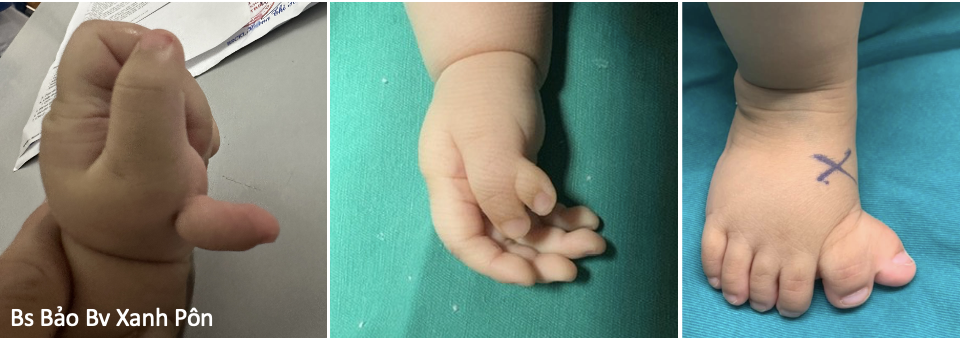 Điều trị Di tật thừa ngón tay, ngón chân ở trẻ em