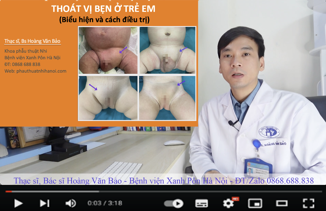 Điều trị Thoát Vị Bẹn ở trẻ em bằng phẫu thuật nội soi không để lại sẹo tại bệnh viện Xanh Pôn Hà Nội