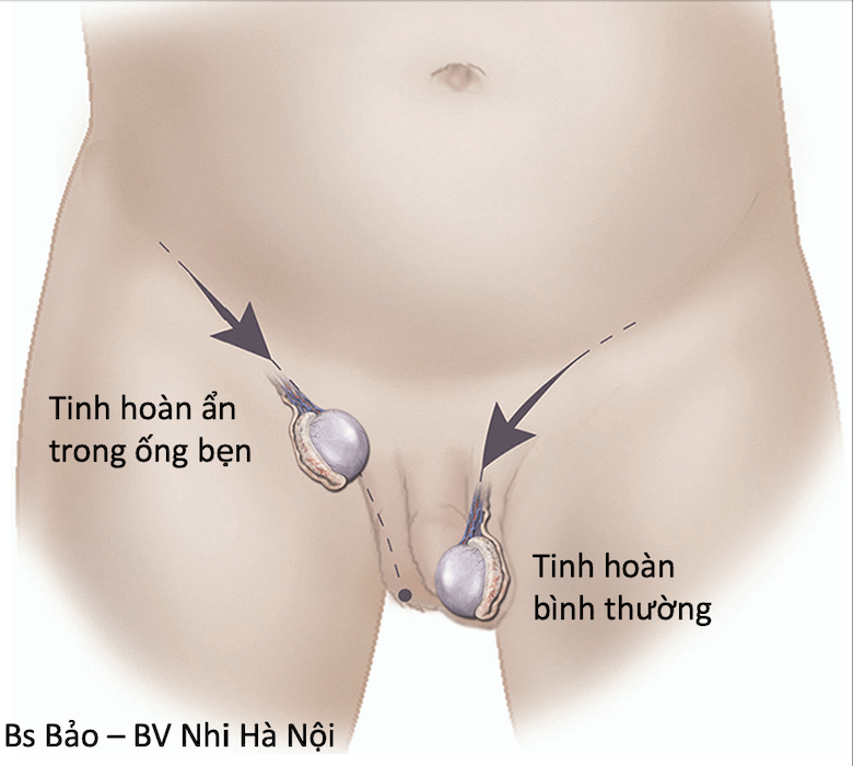 Điều trị ẩn tinh hoàn ở trẻ em tại Bệnh viện Nhi Hà Nội