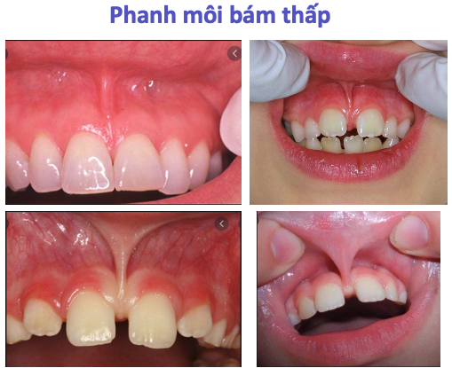 PHANH MÔI BÁM THẤP Ở TRẺ EM